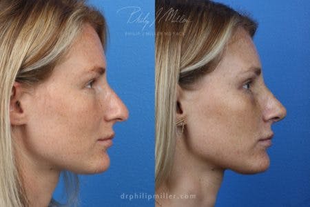 Rhinoplasty/NatraNose Before & After Gallery - Patient 37904726 - Image 1