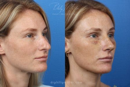 Rhinoplasty/NatraNose Before & After Gallery - Patient 37904726 - Image 2