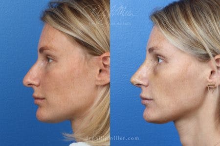 Rhinoplasty/NatraNose Before & After Gallery - Patient 37904726 - Image 3