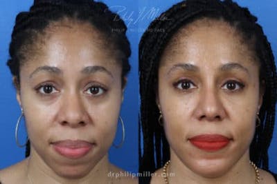 Rhinoplasty/NatraNose Before & After Gallery - Patient 37904729 - Image 1