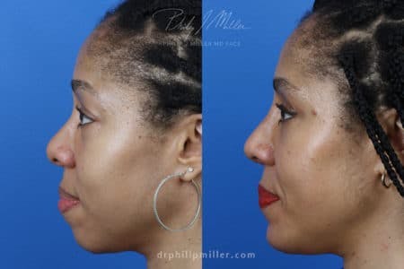 Rhinoplasty/NatraNose Before & After Gallery - Patient 37904729 - Image 2