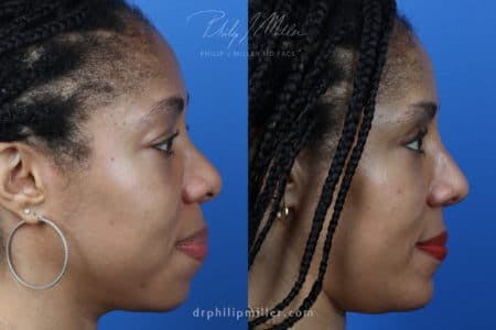 Rhinoplasty/NatraNose Before & After Gallery - Patient 37904729 - Image 3