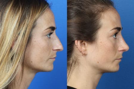 Rhinoplasty/NatraNose Before & After Gallery - Patient 37904733 - Image 1