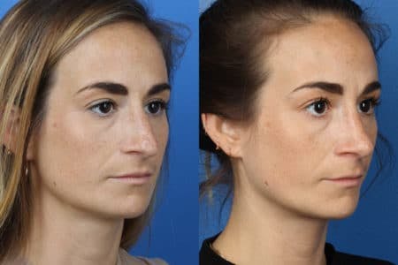 Rhinoplasty/NatraNose Before & After Gallery - Patient 37904733 - Image 2