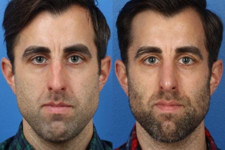 Rhinoplasty/NatraNose Before & After Gallery - Patient 37904735 - Image 2