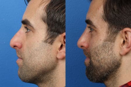 Rhinoplasty/NatraNose Before & After Gallery - Patient 37904735 - Image 1