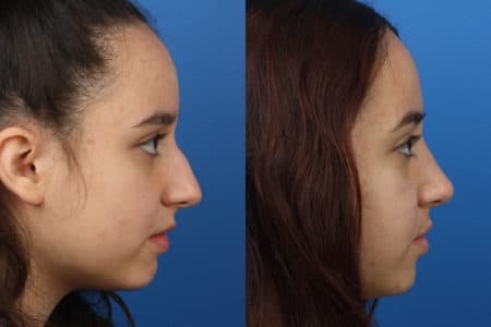 Rhinoplasty/NatraNose Before & After Gallery - Patient 37904737 - Image 1