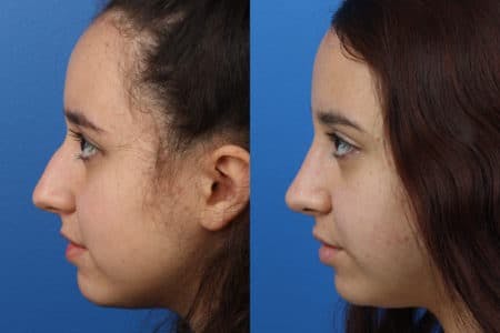 Rhinoplasty/NatraNose Before & After Gallery - Patient 37904737 - Image 2