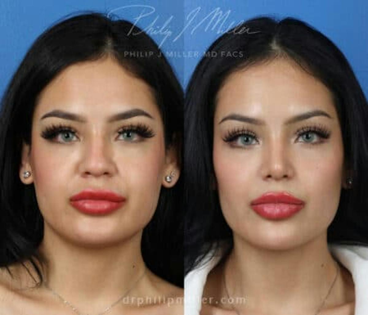 Rhinoplasty/NatraNose Before & After Gallery - Patient 37904741 - Image 1
