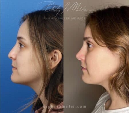 Rhinoplasty/NatraNose Before & After Gallery - Patient 37904742 - Image 1