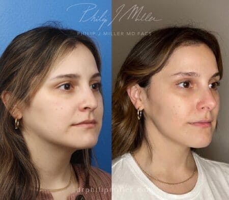 Rhinoplasty/NatraNose Before & After Gallery - Patient 37904742 - Image 2