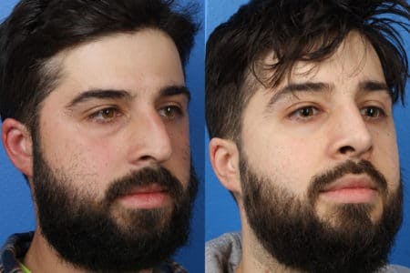 Rhinoplasty/NatraNose Before & After Gallery - Patient 37904745 - Image 2