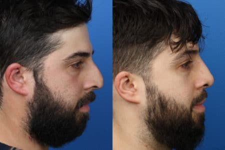 Rhinoplasty/NatraNose Before & After Gallery - Patient 37904745 - Image 3