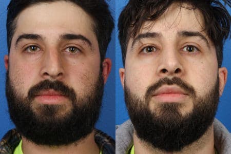 Rhinoplasty/NatraNose Before & After Gallery - Patient 37904745 - Image 4