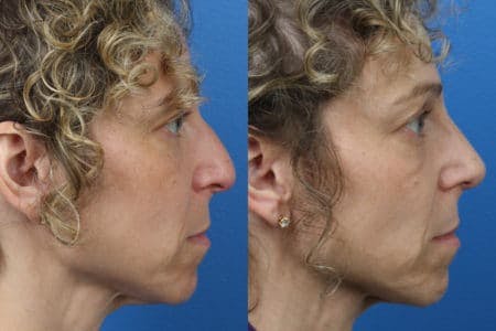 Rhinoplasty/NatraNose Before & After Gallery - Patient 37904751 - Image 1