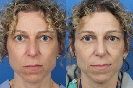 Rhinoplasty/NatraNose Before & After Gallery - Patient 37904751 - Image 2