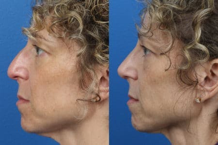 Rhinoplasty/NatraNose Before & After Gallery - Patient 37904751 - Image 3