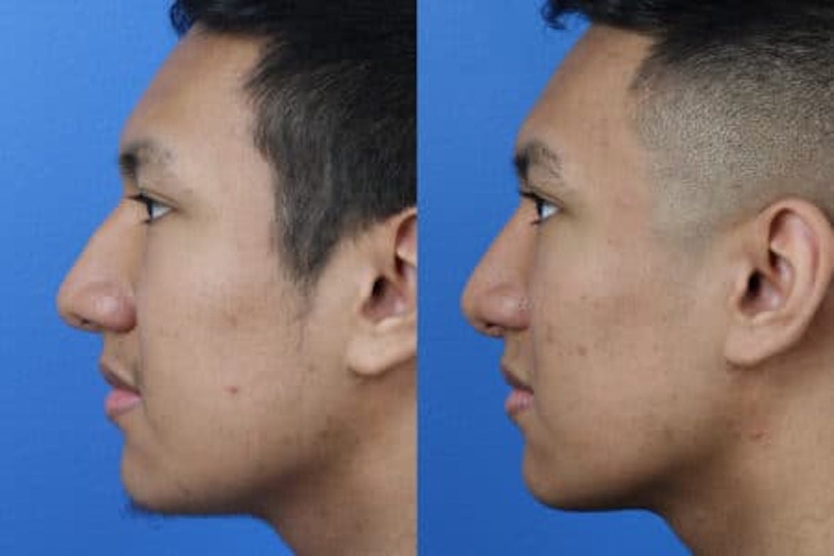 Rhinoplasty/NatraNose Before & After Gallery - Patient 37904757 - Image 1