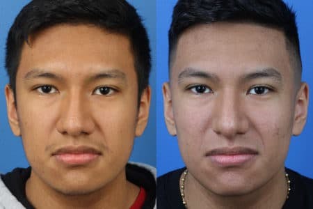 Rhinoplasty/NatraNose Before & After Gallery - Patient 37904757 - Image 2