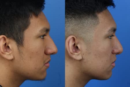 Rhinoplasty/NatraNose Before & After Gallery - Patient 37904757 - Image 3