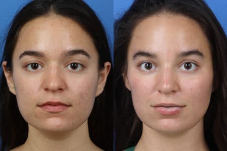 Rhinoplasty/NatraNose Before & After Gallery - Patient 37904761 - Image 1