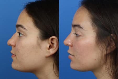 Rhinoplasty/NatraNose Before & After Gallery - Patient 37904761 - Image 2