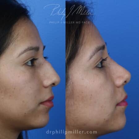 Rhinoplasty/NatraNose Before & After Gallery - Patient 37904764 - Image 1
