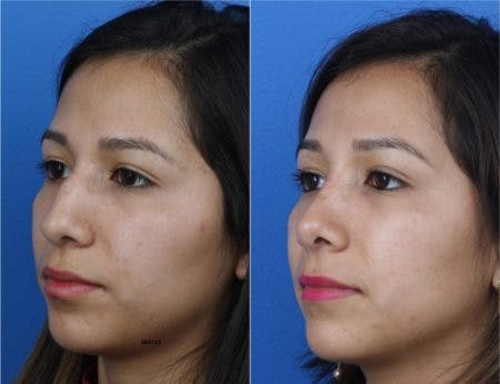 Rhinoplasty/NatraNose Before & After Gallery - Patient 37904764 - Image 2
