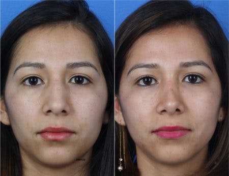 Rhinoplasty/NatraNose Before & After Gallery - Patient 37904764 - Image 3