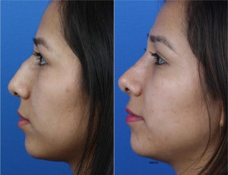 Rhinoplasty/NatraNose Before & After Gallery - Patient 37904764 - Image 4