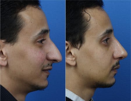 Rhinoplasty/NatraNose Before & After Gallery - Patient 37904768 - Image 1