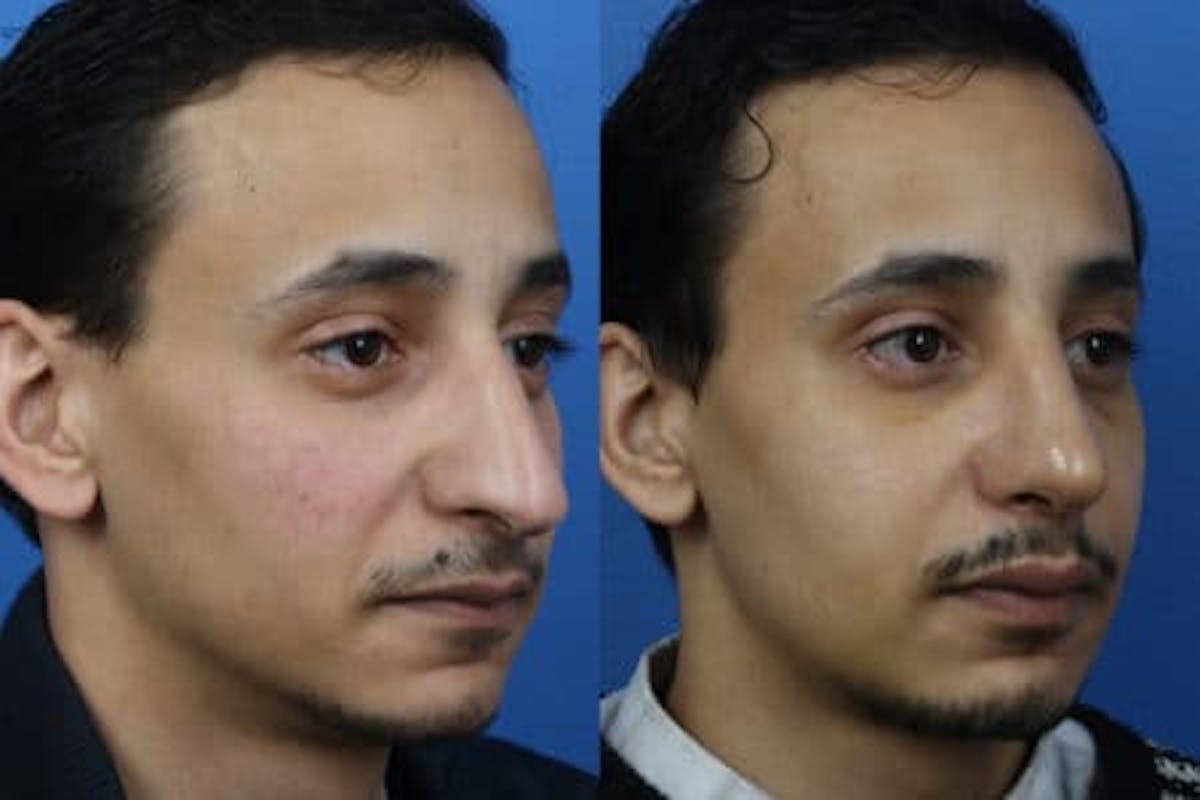 Ethnic Rhinoplasty Before & After Gallery - Patient 37903751 - Image 2