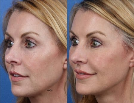 Rhinoplasty/NatraNose Before & After Gallery - Patient 37904770 - Image 2