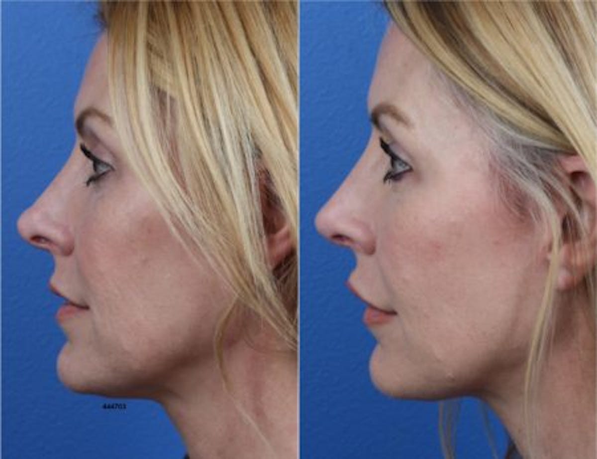 Rhinoplasty/NatraNose Before & After Gallery - Patient 37904770 - Image 1