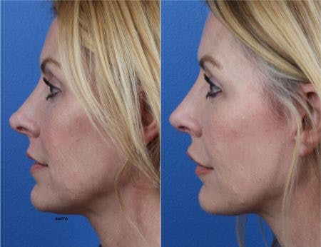 Rhinoplasty/NatraNose Before & After Gallery - Patient 37904770 - Image 1