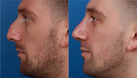 Rhinoplasty/NatraNose Before & After Gallery - Patient 37904772 - Image 1