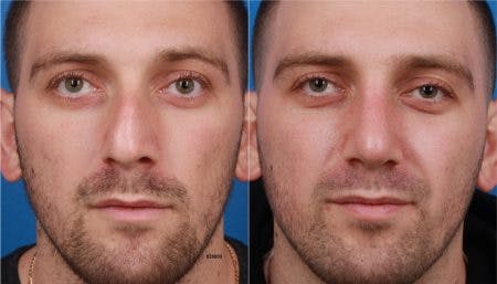 Rhinoplasty/NatraNose Before & After Gallery - Patient 37904772 - Image 2