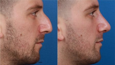 Rhinoplasty/NatraNose Before & After Gallery - Patient 37904772 - Image 3