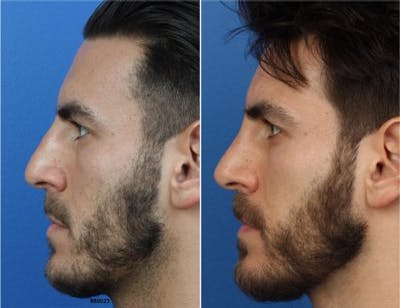 Rhinoplasty/NatraNose Before & After Gallery - Patient 37904775 - Image 1