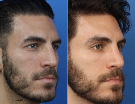 Rhinoplasty/NatraNose Before & After Gallery - Patient 37904775 - Image 2