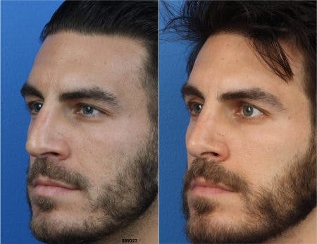 Rhinoplasty/NatraNose Before & After Gallery - Patient 37904775 - Image 3