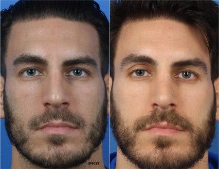 Rhinoplasty/NatraNose Before & After Gallery - Patient 37904775 - Image 4