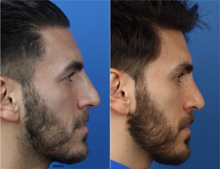 Rhinoplasty/NatraNose Before & After Gallery - Patient 37904775 - Image 5