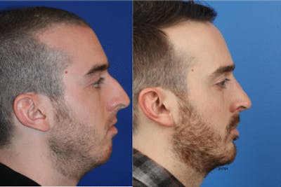 Rhinoplasty/NatraNose Before & After Gallery - Patient 37904780 - Image 1
