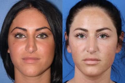 Rhinoplasty/NatraNose Before & After Gallery - Patient 37904781 - Image 1