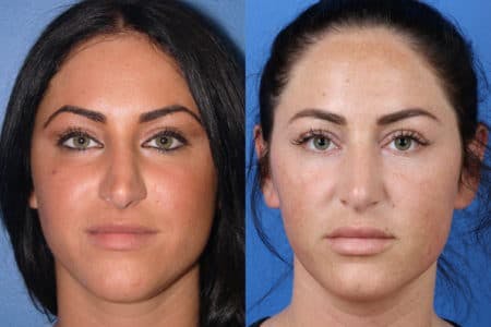 Rhinoplasty/NatraNose Before & After Gallery - Patient 37904781 - Image 1