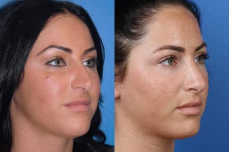Rhinoplasty/NatraNose Before & After Gallery - Patient 37904781 - Image 2