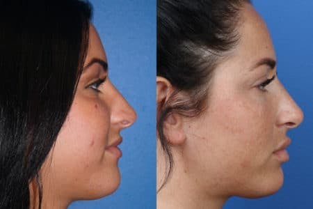 Rhinoplasty/NatraNose Before & After Gallery - Patient 37904781 - Image 3
