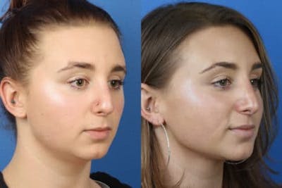 Rhinoplasty/NatraNose Before & After Gallery - Patient 37904787 - Image 1