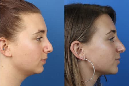 Rhinoplasty/NatraNose Before & After Gallery - Patient 37904787 - Image 2